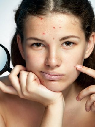 skin care for acne prone