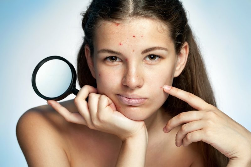 skin care for acne prone