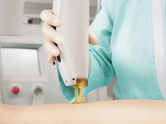 IPL & Laser Hair Removal: Upgrades & Recent Advancements in Technology